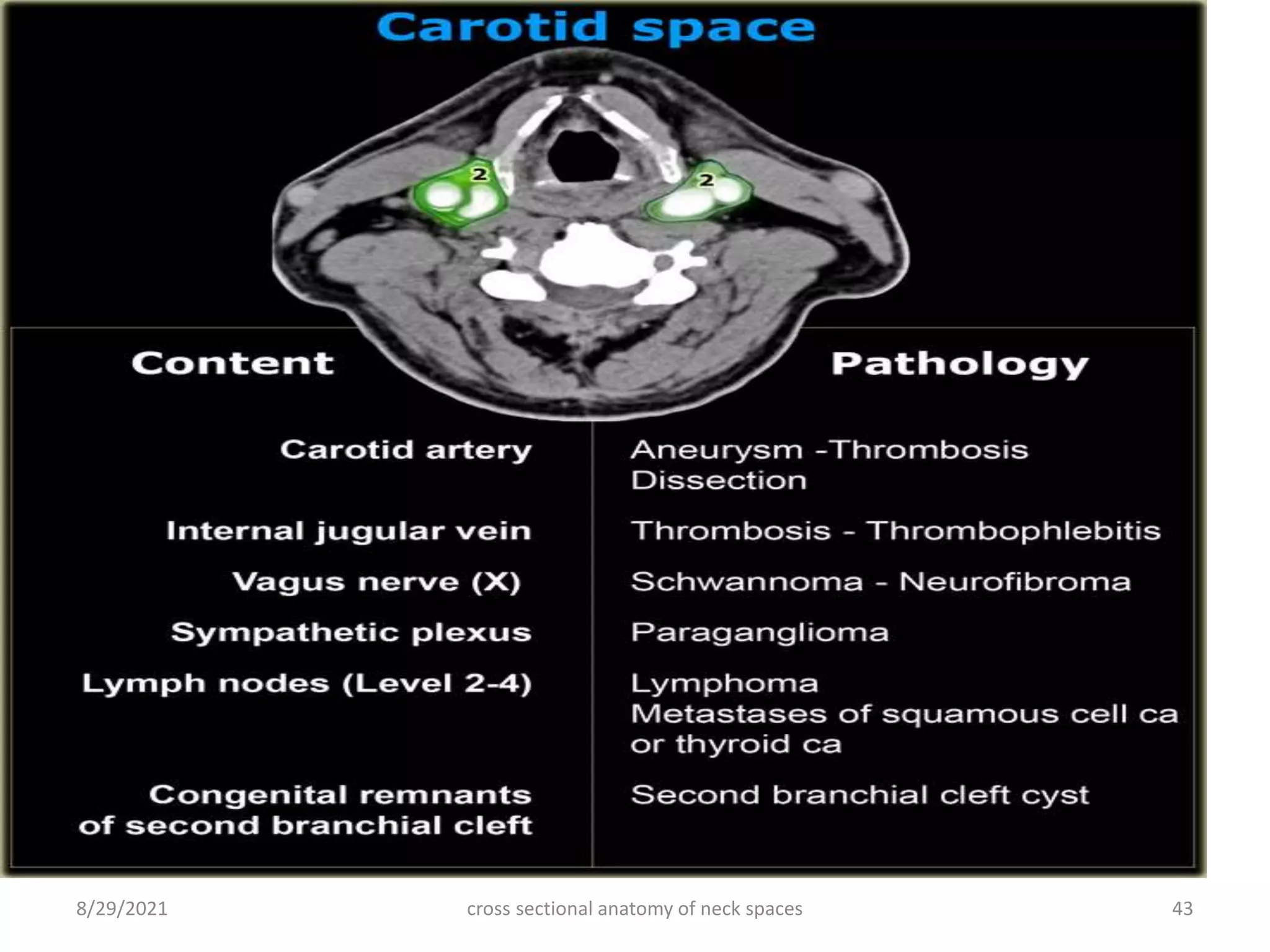 cross sectional anatomy of neck spaces 43
8/29/2021
 