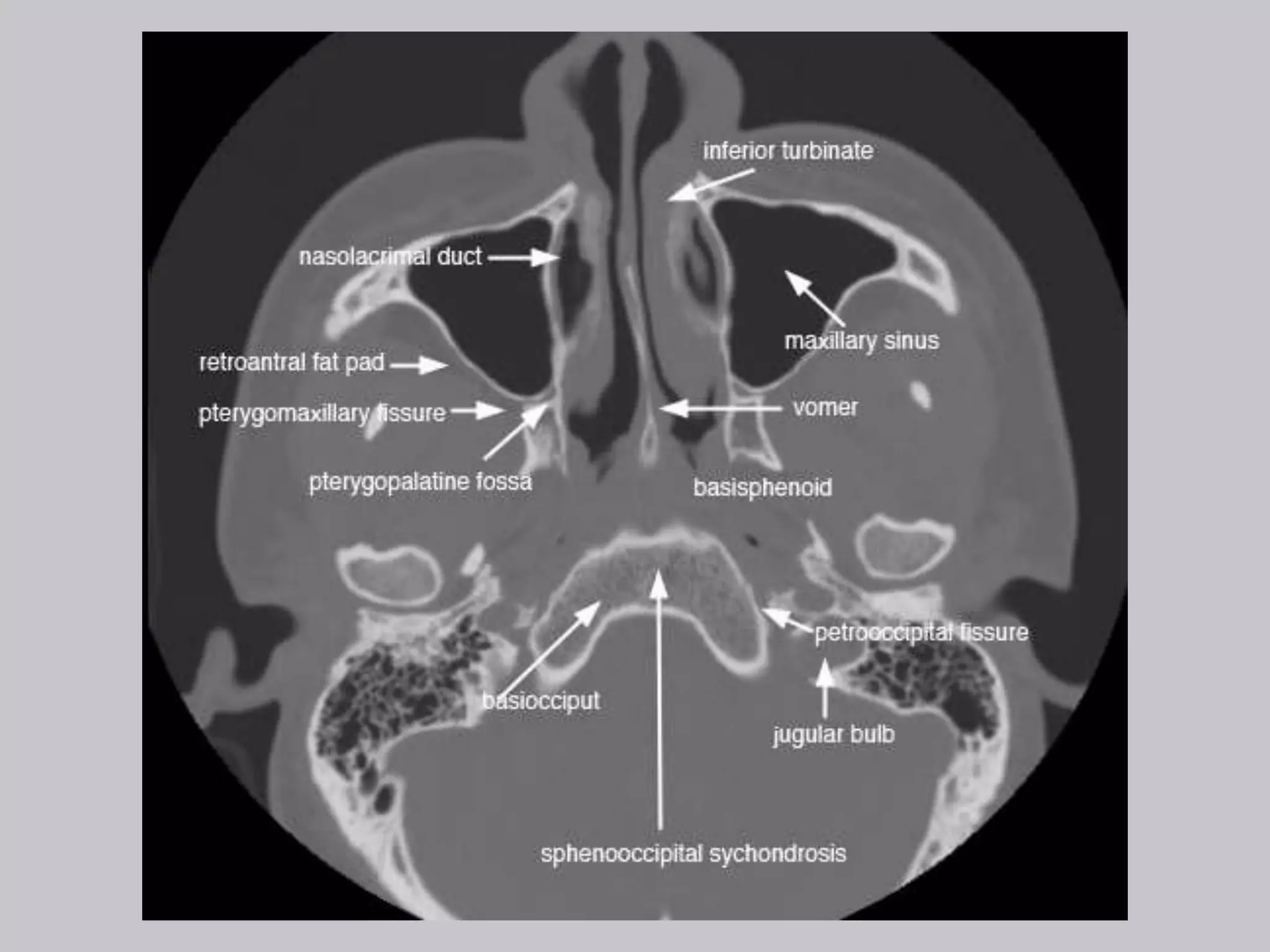 Neuroradiology threads by Lea Alhilali - Functional Endoscopic Sinus  Surgery | Radiopaedia.org, image size:2048x1536