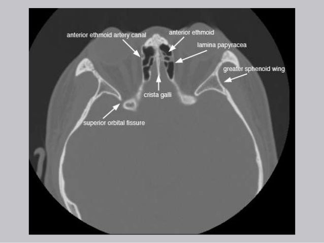 Cross Sectional Anatomy of Paranasal sinus