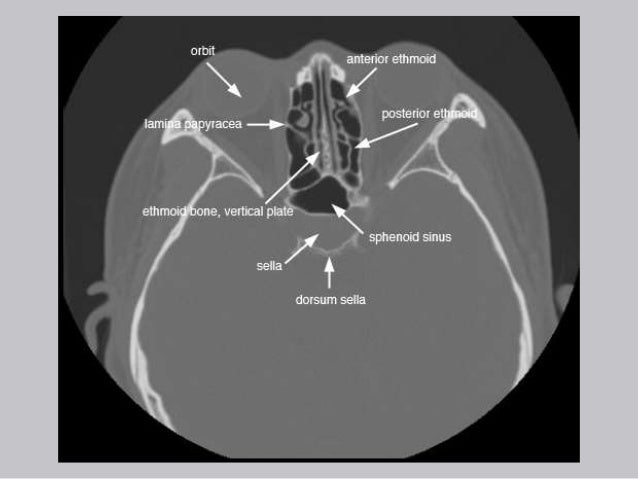 Cross Sectional Anatomy of Paranasal sinus