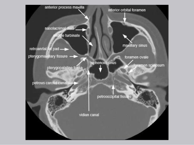 Cross Sectional Anatomy Of Paranasal Sinus Cross Sectional Anatomy Of Paranasal Sinus