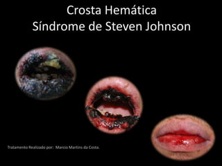 Crosta HemáticaSíndrome de Steven Johnson Tratamento Realizado por:  Marcio Martins da Costa. 