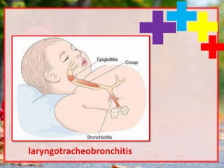 laryngotracheobronchitis
 