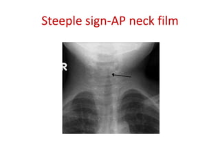 Steeple sign-AP neck film
 