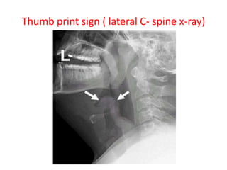 Thumb print sign ( lateral C- spine x-ray)
 