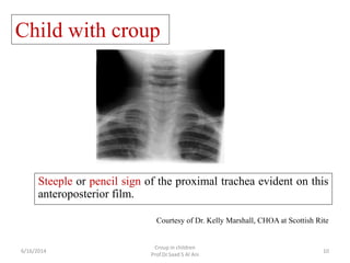 Steeple or pencil sign of the proximal trachea evident on this
anteroposterior film.
Child with croup
Courtesy of Dr. Kell...