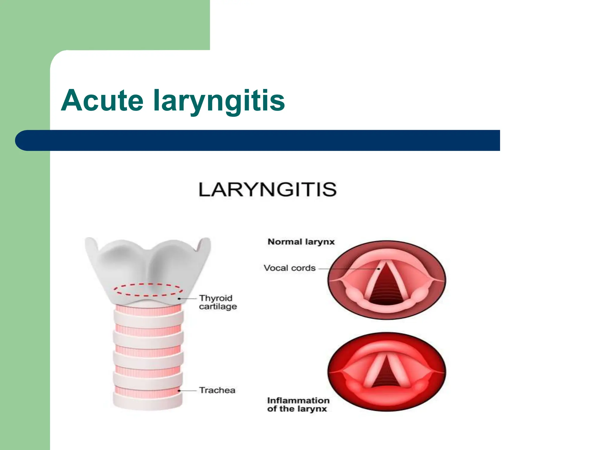 Acute laryngitis
 