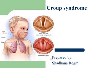 Croup syndrome
Prepared by:
Shadhana Regmi
 