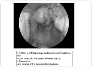 FIGURE 2. Intraoperative endoscopic examination of
the
upper airway in the patient showed marked
inflammation
and edema of the supraglottic structures.
 