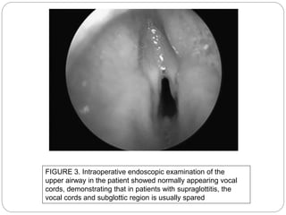 FIGURE 3. Intraoperative endoscopic examination of the
upper airway in the patient showed normally appearing vocal
cords, demonstrating that in patients with supraglottitis, the
vocal cords and subglottic region is usually spared
 