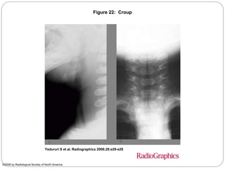 Figure 22: Croup
Yedururi S et al. Radiographics 2008;28:e29-e29
©2008 by Radiological Society of North America
 