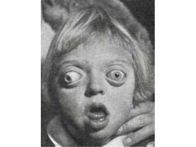Crouzon syndrome