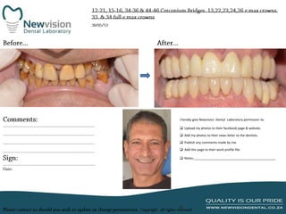 I hereby give Newvision Dental Laboratory permission to:
 Upload my photos to their facebook page & website.
 Add my photos to their news letter to the dentists.
 Publish any comments made by me.
 Add this page to their work profile file.
 Notes:______________________________________________

 