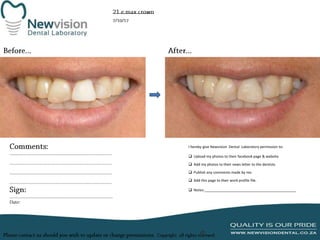 I hereby give Newvision Dental Laboratory permission to:
 Upload my photos to their facebook page & website.
 Add my photos to their news letter to the dentists.
 Publish any comments made by me.
 Add this page to their work profile file.
 Notes:______________________________________________

 
