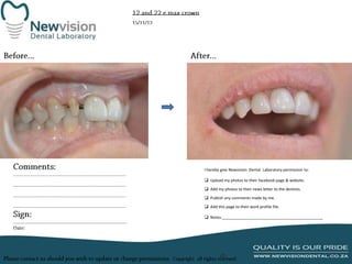 I hereby give Newvision Dental Laboratory permission to:
 Upload my photos to their facebook page & website.
 Add my photos to their news letter to the dentists.
 Publish any comments made by me.
 Add this page to their work profile file.
 Notes:______________________________________________

 