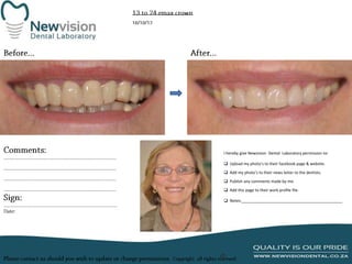 I hereby give Newvision Dental Laboratory permission to:
 Upload my photo’s to their facebook page & website.
 Add my photo’s to their news letter to the dentists.

 Publish any comments made by me.
 Add this page to their work profile file.
 Notes:______________________________________________

 