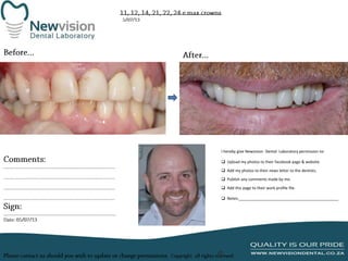 I hereby give Newvision Dental Laboratory permission to:
 Upload my photos to their facebook page & website.
 Add my photos to their news letter to the dentists.

 Publish any comments made by me.
 Add this page to their work profile file.
 Notes:______________________________________________

 