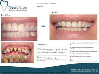 I hereby give Newvision Dental Laboratory permission
to:
 Upload my photos to their facebook page &
website.
 Add my photo’s to their news letter to the dentists.
 Publish any comments made by me.
 Add this page to their work profile file.

Notes:_______________________________________

 