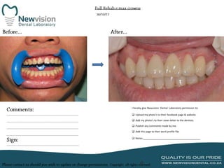 I hereby give Newvision Dental Laboratory permission to:
 Upload my photo’s to their facebook page & website.
 Add my photo’s to their news letter to the dentists.
 Publish any comments made by me.
 Add this page to their work profile file.
 Notes:_________________________________________

 