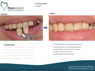 I hereby give Newvision Dental Laboratory permission to:
 Upload my photo’s to their facebook page & website.
 Add my photo’s to their news letter to the dentists.
 Publish any comments made by me.
 Add this page to their work profile file.

 