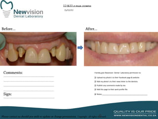 I hereby give Newvision Dental Laboratory permission to:
 Upload my photo’s to their facebook page & website.
 Add my photo’s to their news letter to the dentists.
 Publish any comments made by me.
 Add this page to their work profile file.
 Notes:______________________________________________

 