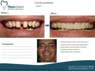 I hereby give Newvision Dental Laboratory permission to:

 Upload my photo’s to their facebook page & website.
 Add my photo’s to their news letter to the dentists.
 Publish any comments made by me.
 Add this page to their work profile file.

 