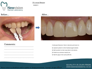 I hereby give Newvision Dental Laboratory permission to:
 Upload my photo’s to their facebook page & website.
 Add my photo’s to their news letter to the dentists.
 Publish any comments made by me.
 Add this page to their work profile file.

 