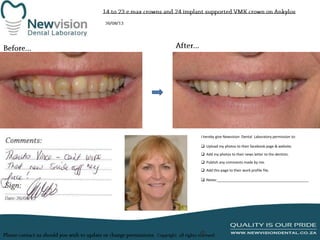 I hereby give Newvision Dental Laboratory permission to:
 Upload my photos to their facebook page & website.
 Add my photos to their news letter to the dentists.
 Publish any comments made by me.
 Add this page to their work profile file.
 Notes:______________________________________________

 