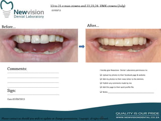 I hereby give Newvision Dental Laboratory permission to:
 Upload my photos to their facebook page & website.
 Add my photos to their news letter to the dentists.

 Publish any comments made by me.
 Add this page to their work profile file.
 Notes:______________________________________________

 
