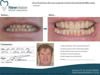 I hereby give Newvision Dental Laboratory permission to:
 Upload my photos to their facebook page & website.
 Add my photos to their news letter to the dentists.
 Publish any comments made by me.
 Add this page to their work profile file.
 Notes:______________________________________________

 