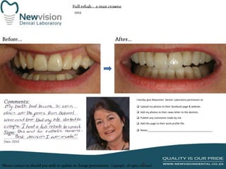 I hereby give Newvision Dental Laboratory permission to:

 Upload my photos to their facebook page & website.
 Add my photos to their news letter to the dentists.
 Publish any comments made by me.
 Add this page to their work profile file.
 Notes:______________________________________________

 