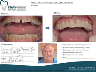 I hereby give Newvision Dental Laboratory permission to:
 Upload my photos to their facebook page & website.
 Add my photos to their news letter to the dentists.
 Publish any comments made by me.
 Add this page to their work profile file.
 Notes:______________________________________________

 