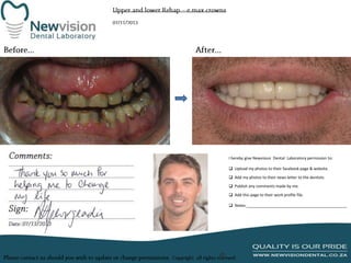 I hereby give Newvision Dental Laboratory permission to:
 Upload my photos to their facebook page & website.
 Add my photos to their news letter to the dentists.
 Publish any comments made by me.
 Add this page to their work profile file.
 Notes:______________________________________________

 