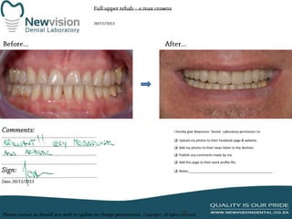 I hereby give Newvision Dental Laboratory permission to:
 Upload my photos to their facebook page & website.
 Add my photos to their news letter to the dentists.
 Publish any comments made by me.
 Add this page to their work profile file.
 Notes:______________________________________________

 