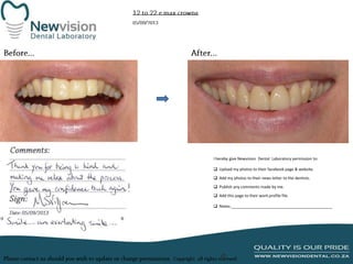 I hereby give Newvision Dental Laboratory permission to:
 Upload my photos to their facebook page & website.
 Add my photos to their news letter to the dentists.
 Publish any comments made by me.
 Add this page to their work profile file.
 Notes:______________________________________________

 
