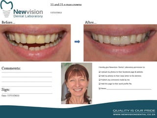 I hereby give Newvision Dental Laboratory permission to:
 Upload my photos to their facebook page & website.
 Add my photos to their news letter to the dentists.
 Publish any comments made by me.
 Add this page to their work profile file.
 Notes:______________________________________________

 