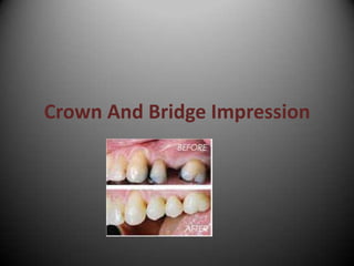 Crown And Bridge Impression
 