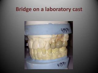 Bridge on a laboratory cast
 