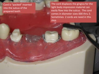 Cord is “packed” inserted
into the sulcus of the
prepared teeth
The cord displaces the gingiva for the
light body impression material can
easily flow into the sulcus. The cord
comes in diameter sizes 000 thru 3.
Sometimes 2 cords are need in this
step.
 
