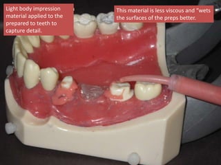Light body impression
material applied to the
prepared to teeth to
capture detail.
This material is less viscous and “wets
the surfaces of the preps better.
 