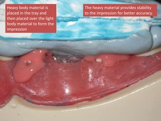 Heavy body material is
placed in the tray and
then placed over the light
body material to form the
impression
The heavy material provides stability
to the impression for better accuracy.
 