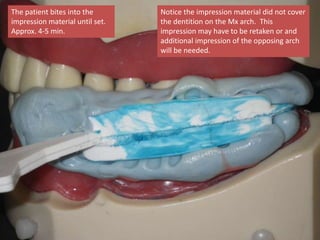The patient bites into the
impression material until set.
Approx. 4-5 min.
Notice the impression material did not cover
the dentition on the Mx arch. This
impression may have to be retaken or and
additional impression of the opposing arch
will be needed.
 