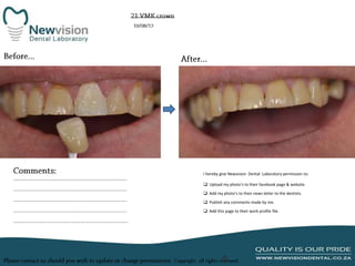 I hereby give Newvision Dental Laboratory permission to:
 Upload my photo’s to their facebook page & website.
 Add my photo’s to their news letter to the dentists.
 Publish any comments made by me.
 Add this page to their work profile file.

 