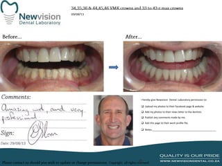 I hereby give Newvision Dental Laboratory permission to:
 Upload my photos to their facebook page & website.
 Add my photos to their news letter to the dentists.
 Publish any comments made by me.
 Add this page to their work profile file.
 Notes:______________________________________________

 