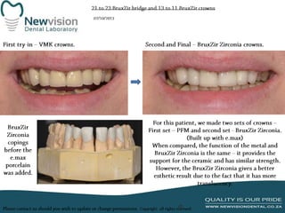 Crown and bridge vmk and bruxir work presentation