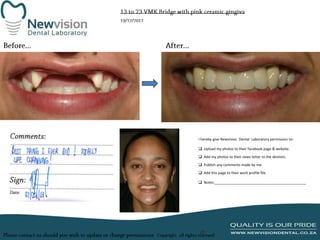 I hereby give Newvision Dental Laboratory permission to:
 Upload my photos to their facebook page & website.
 Add my photos to their news letter to the dentists.

 Publish any comments made by me.
 Add this page to their work profile file.
 Notes:______________________________________________

 