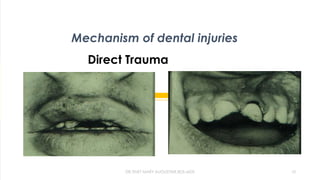 Mechanism of dental injuries
Direct Trauma
DR.TINET MARY AUGUSTINE.BDS.MDS 10
 