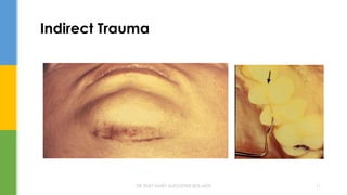 Indirect Trauma
DR.TINET MARY AUGUSTINE.BDS.MDS 11
 