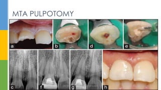 MTA PULPOTOMY
DR.TINET MARY AUGUSTINE.BDS.MDS 138
 