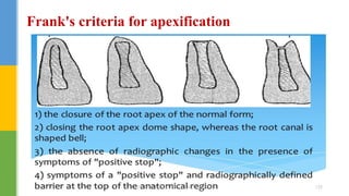 Frank's criteria for apexification
DR.TINET MARY AUGUSTINE.BDS.MDS 155
 
